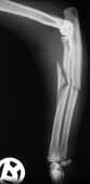 Fraktur Unterarm